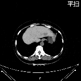 国科大肿瘤医院放射科再填“利器”! 引进高端CT Ingenuity