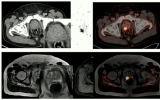 PET/MRI在的最佳应用出现在4个关键临床领域