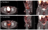新兴的PSMA PET试剂可能改善前列腺癌的检测