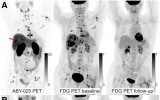 全身PET/CT可预测转移性乳腺癌患者HER2靶向治疗的疗效